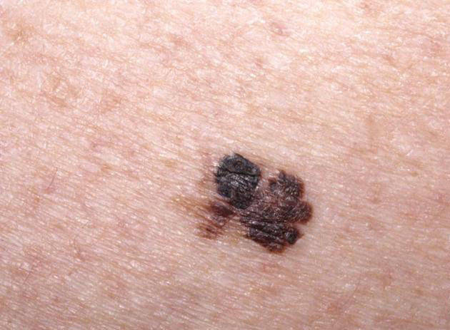 黑色素瘤高发要警惕,皮肤出现这4种异常要赶快上医院,避免惹上恶性