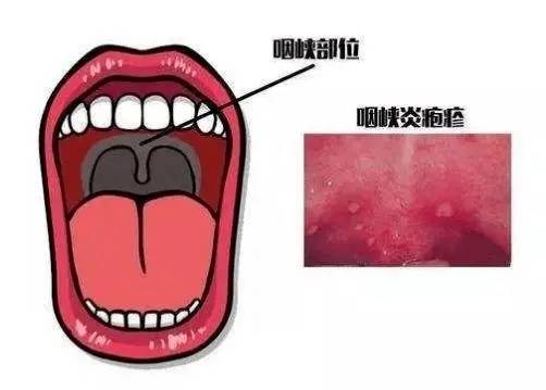 疾控话健康|疱疹性咽峡炎是手足口病的