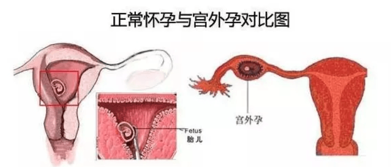 女性＂宫外孕＂和男性息息相关,若丈夫有这些行为,妻子难幸免