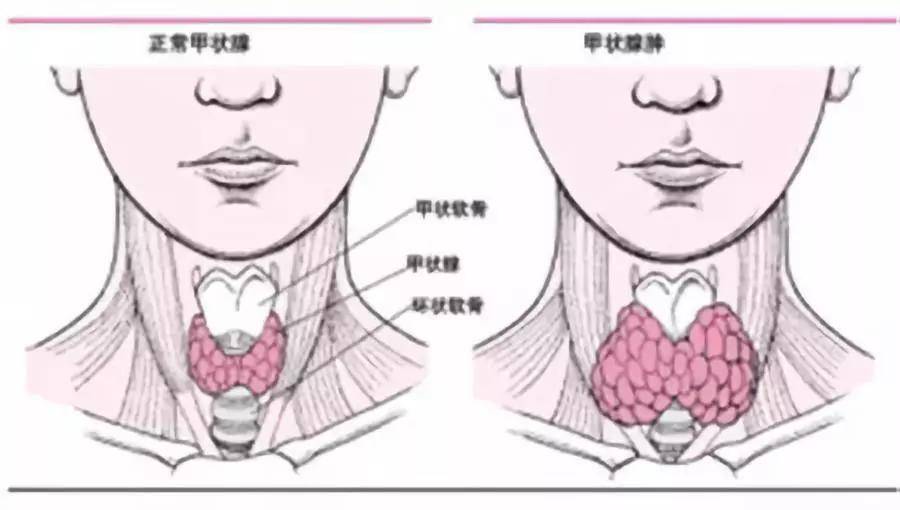 张先慧主任分享:甲状腺疾病有这6个区别,教你分清甲亢