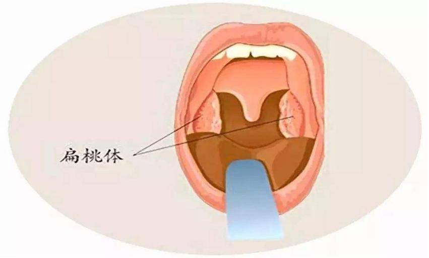 一个叫舌腭弓,一个叫咽腭弓,分别跨在两侧,形成两个窝,其内即扁桃体.