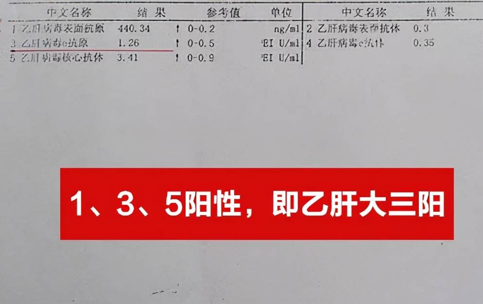 肝病专家潘运华:忽视乙肝病毒,26岁小伙病情恶化成大三阳