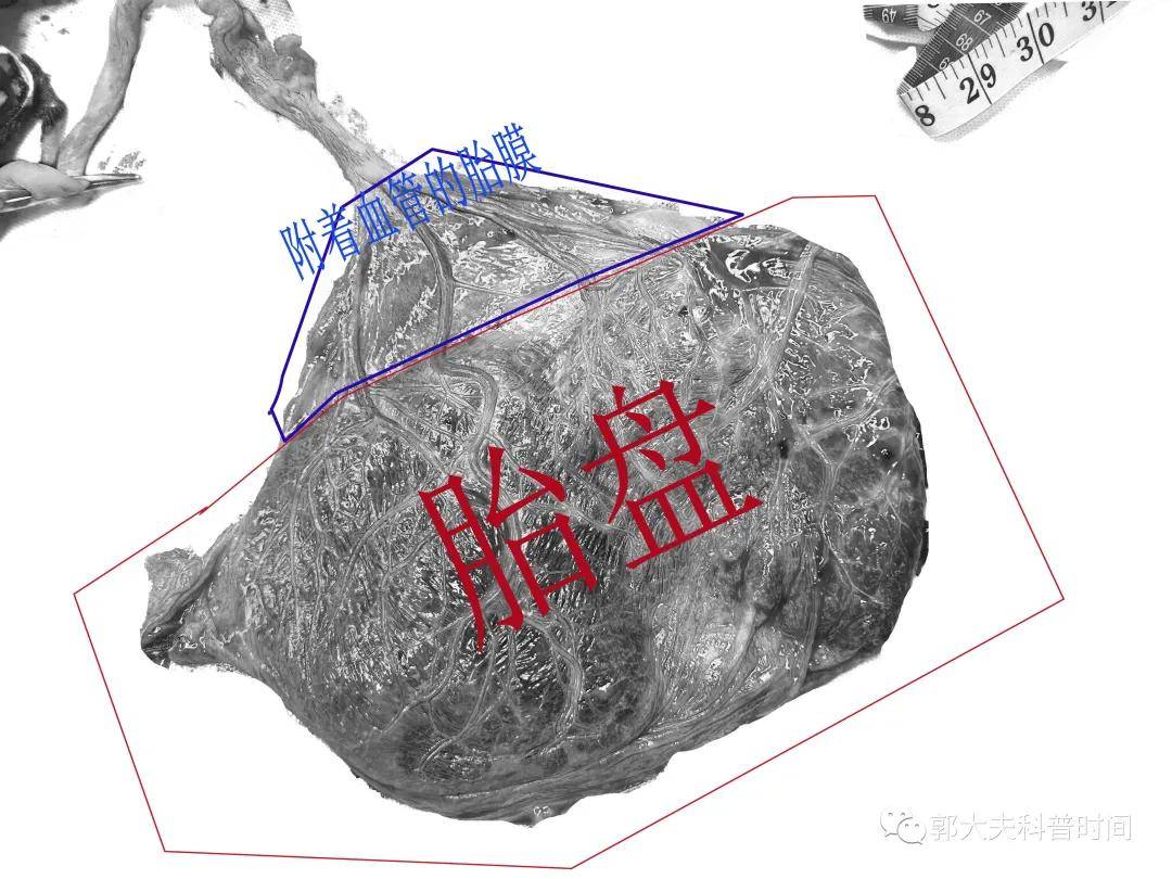 帆状胎盘