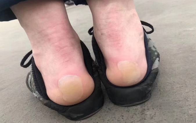 训练中脚后跟磨起的水泡