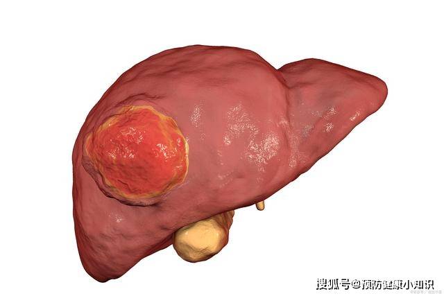 1,肿瘤标志物血清甲胎蛋白是肝癌的肿瘤标志物,常常用来辅助诊断肝癌