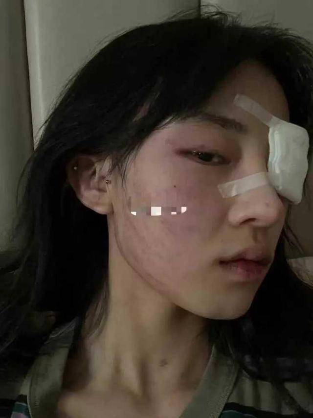 原创百万粉网红被家暴:双眼肿得像核桃口罩都是血,直言把男友送警局