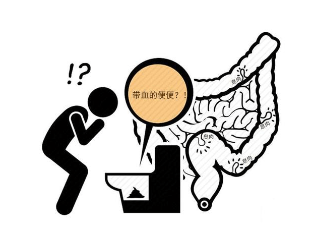 大便形状变细,警惕4种疾病造访