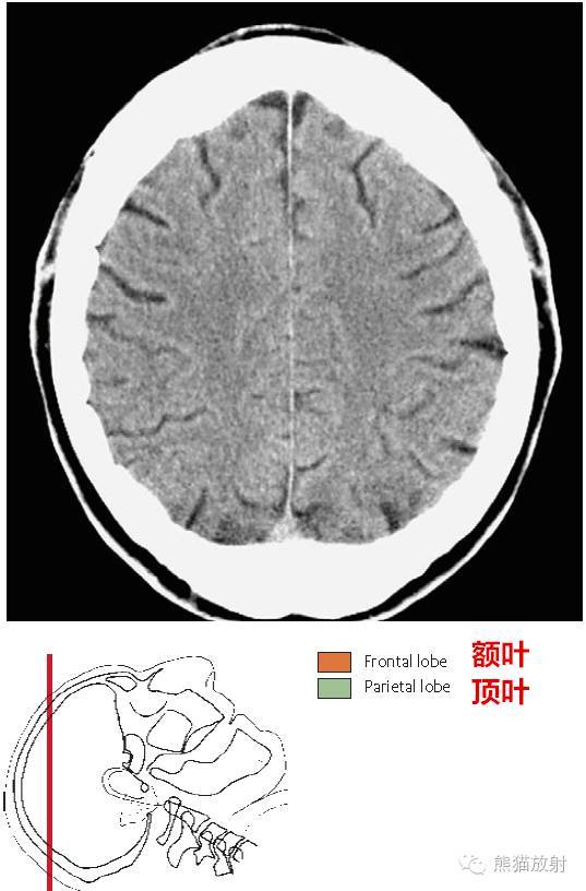 解剖颅脑ct断层中英文对照干货满满