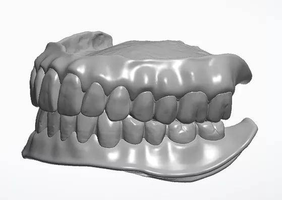 干货全口活动义齿数字化制作方法