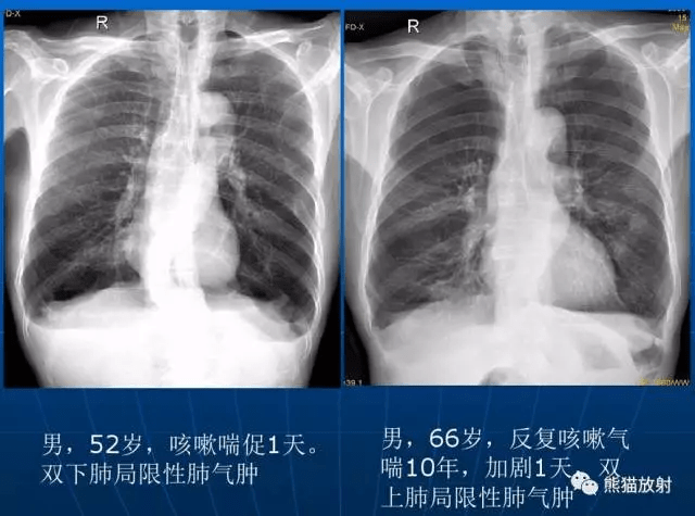 【x线诊断要点】关于"肺气肿"的一些概念,需要熟悉(结合ct)_支气管