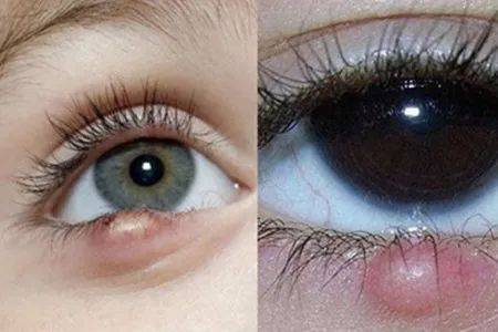 "针眼"是睑腺炎的俗称,又称"麦粒肿",是由眼睑的睑板腺或毛囊及其附属