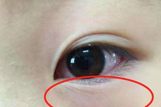 5, 脾胃运化差,鼻梁出现青筋,有明显的"眼袋".