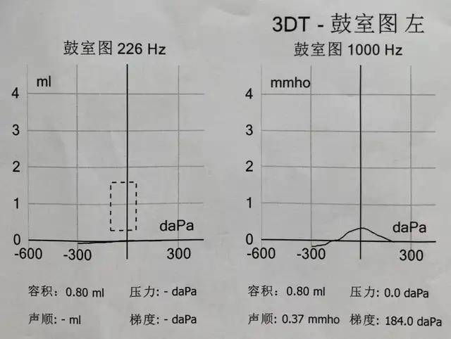 侧别1k hz鼓室曲线226 hz鼓室曲线鼓