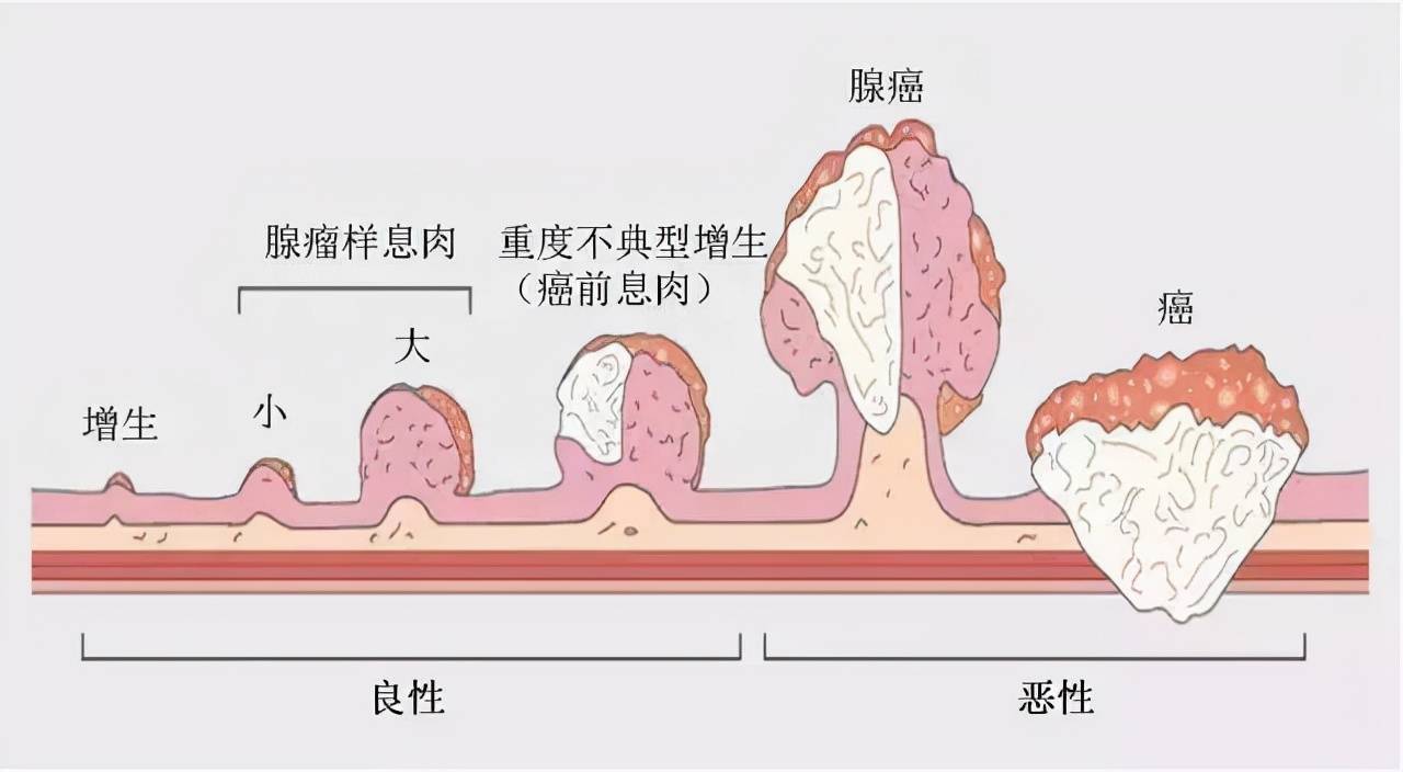 问题四:如何减少腺瘤镜下的漏诊率?