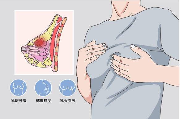 或出现乳房皮肤"酒窝"样凹陷,或有多个皮下小结节,这是乳腺癌的主要