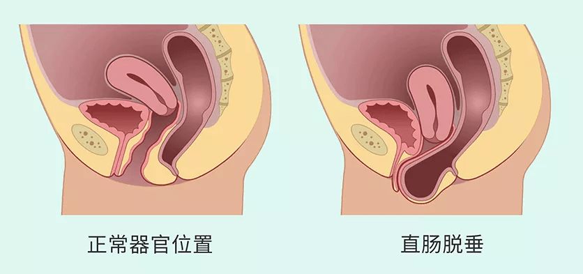 (2)阴道后壁膨出(直肠脱垂)膀胱脱垂会影响到尿道,在咳嗽或剧烈运动时