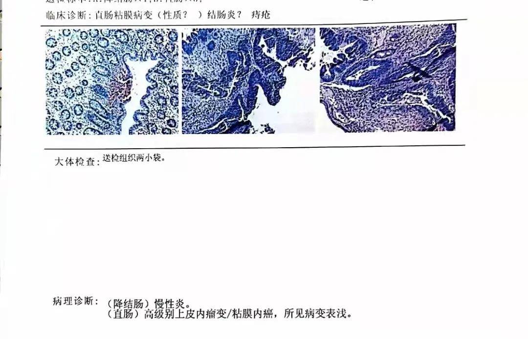 肠镜检查结果是上皮内瘤变是肠癌的危险信号