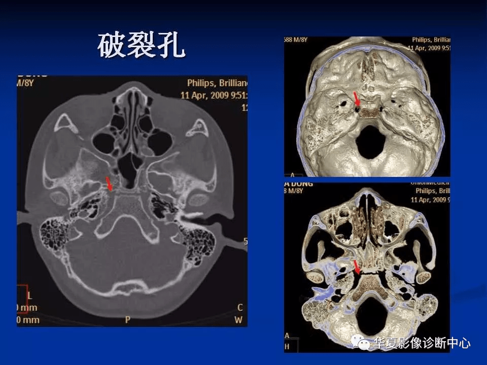 实用详细的颅底各孔道影像解剖