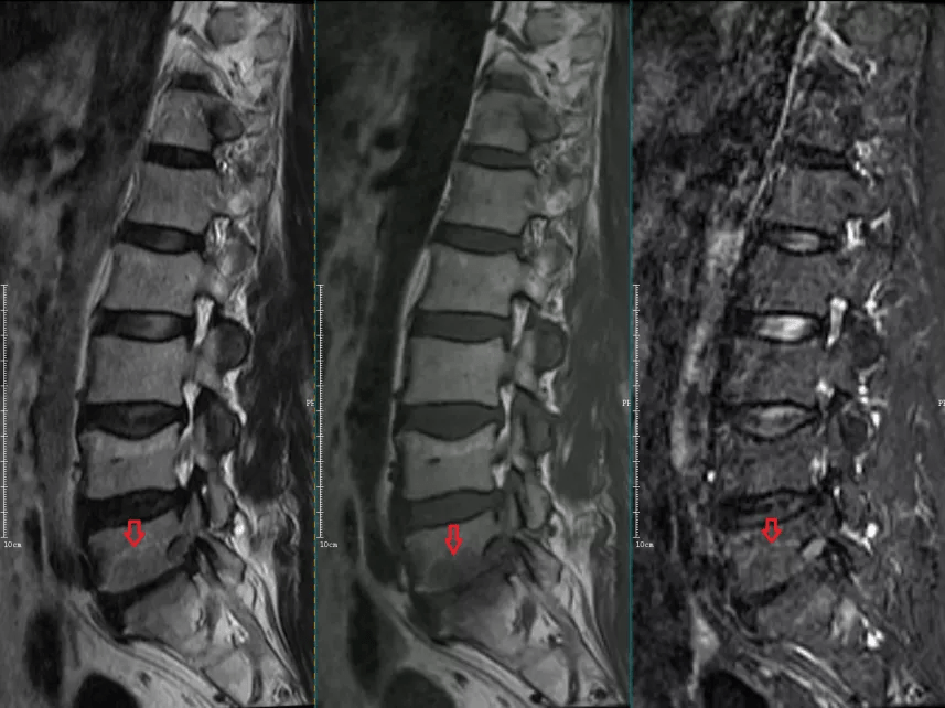 椎体终板炎 发生机制,分型以及 mri 表现_椎间盘_信号_序列