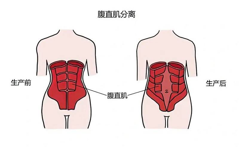 无论是顺产还是剖腹产都逃不过的腹直肌分离拿什么拯救你