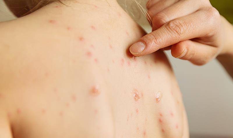 原创单纯疱疹病毒感染常发病在皮肤表面有传染性有症状便就医