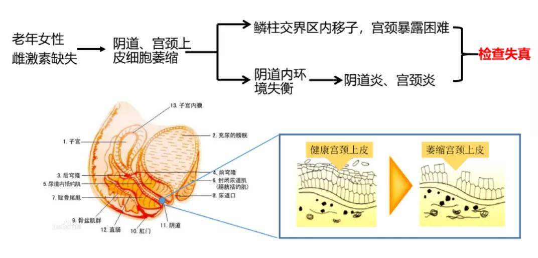 而普罗雌烯可促进阴道,宫颈黏膜上皮细胞增殖,可显著提高镜检充分性