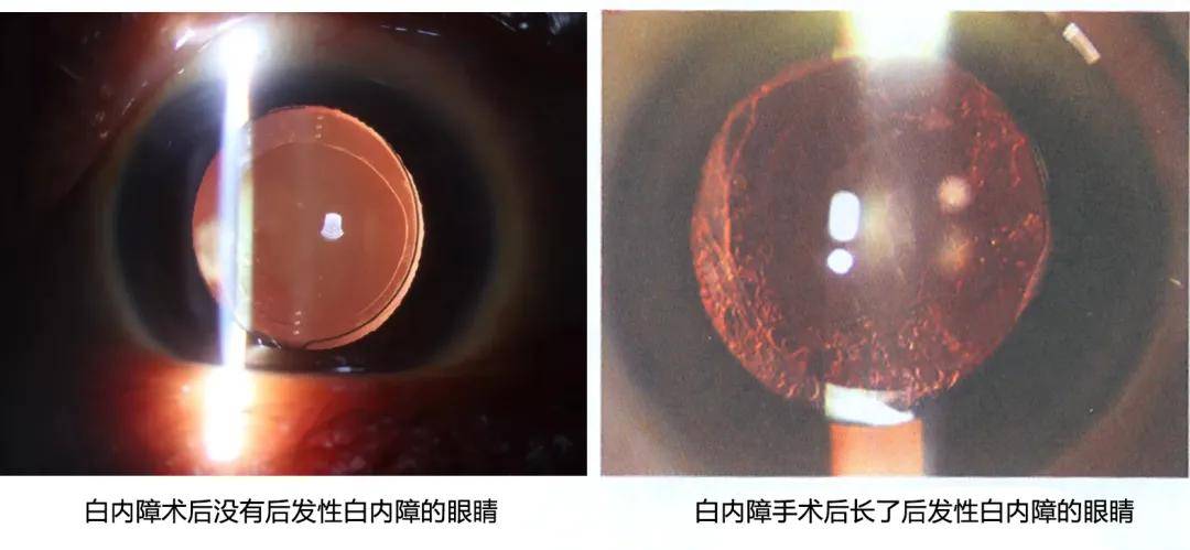 后发性白内障一般无须再手术,患者只需要在门诊做一个yag激光治疗就行