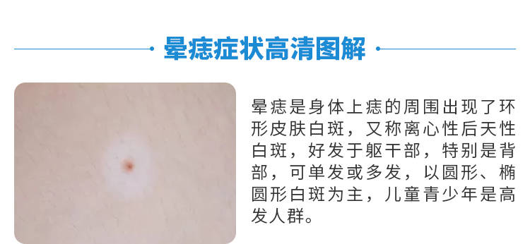 晕痣能自愈吗合肥华夏白癜风医院治疗晕痣有效吗