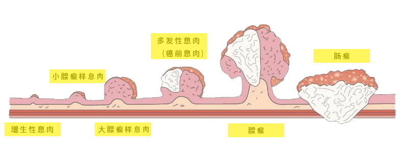 4毫米的小息肉3年变腺瘤你还在轻视息肉的威力吗