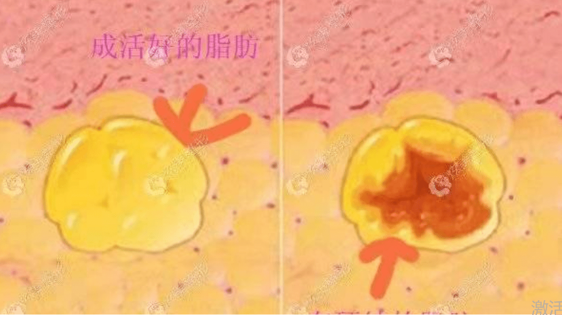 后悔:脂肪填充后有硬疙瘩怎么办:脂肪填充后形成结节该如何处理?