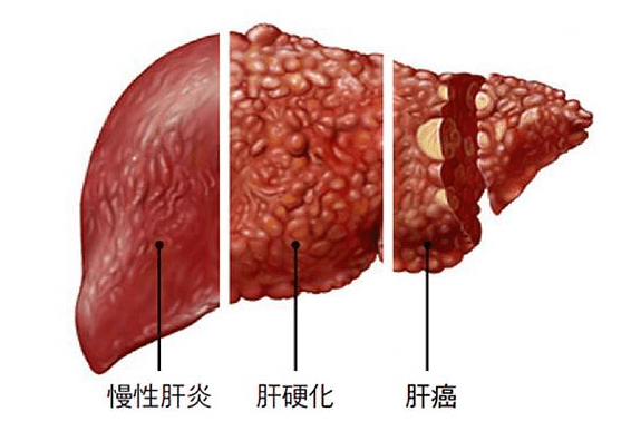 并形成再生结节和假小叶,导致正常肝小叶结构和血管解剖的破坏