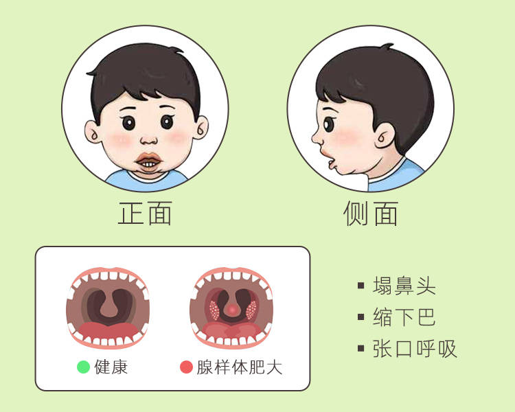 腺样体又称咽扁桃体,由于腺样体肥大导致面骨发育发生障碍,颌骨变长