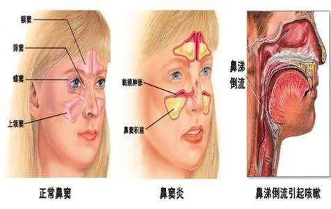 什么叫副鼻窦炎 来自搜狐网