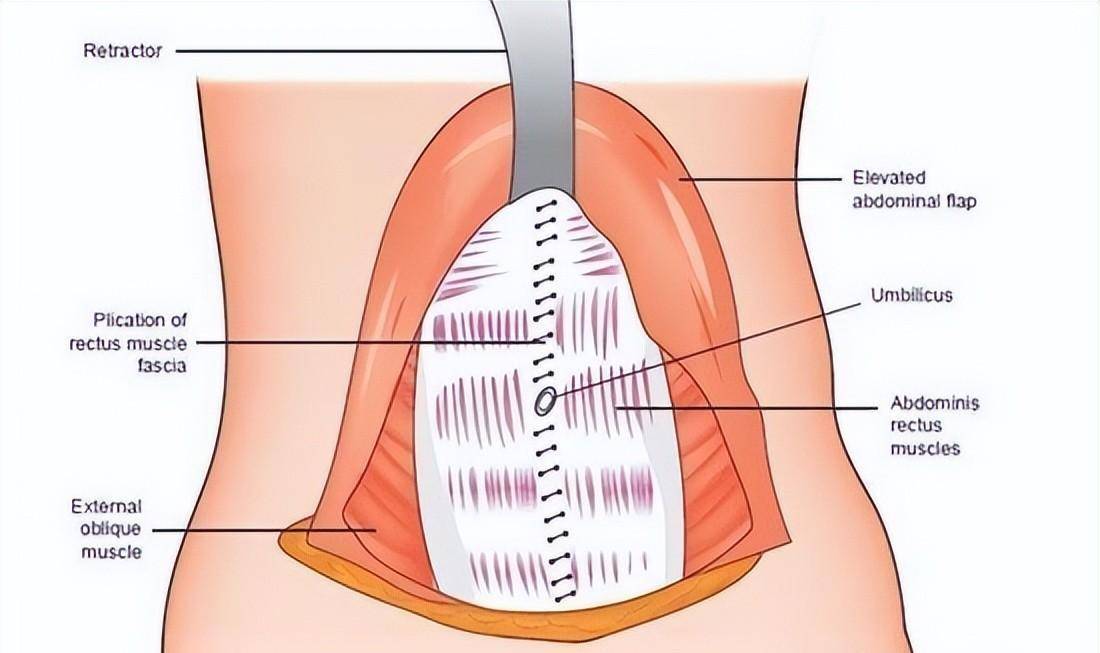 接受不了“大腹婆”，把“腹壁整形”做了，我们来聊一聊手术细节