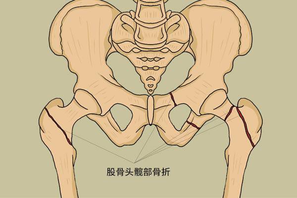 老年人摔一跤，后果有多严峻？年过60，3种食物要常吃，养骨壮骨