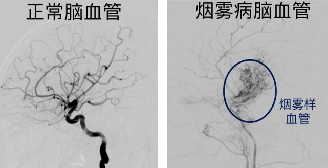 烟雾病与脑卒中有什么关系？