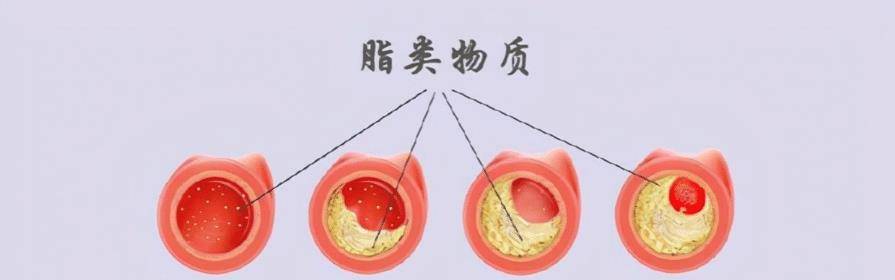 降血脂，阿托伐他汀和瑞舒伐他汀需要瓜代吃吗？医生说出准确做法