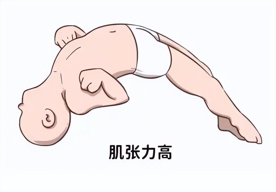 肌张力高通俗来说就是感觉孩子很硬，出现剪刀步，脚后跟放不下去，手伸
