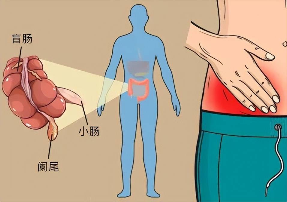 阑尾炎是“小毛病”？医生：它可不简单！
