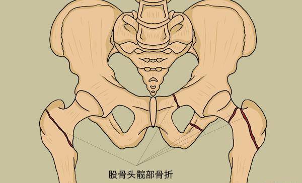 一摔倒就骨折，怎么回事？50岁后，3种营养要舍得补，强身健骨