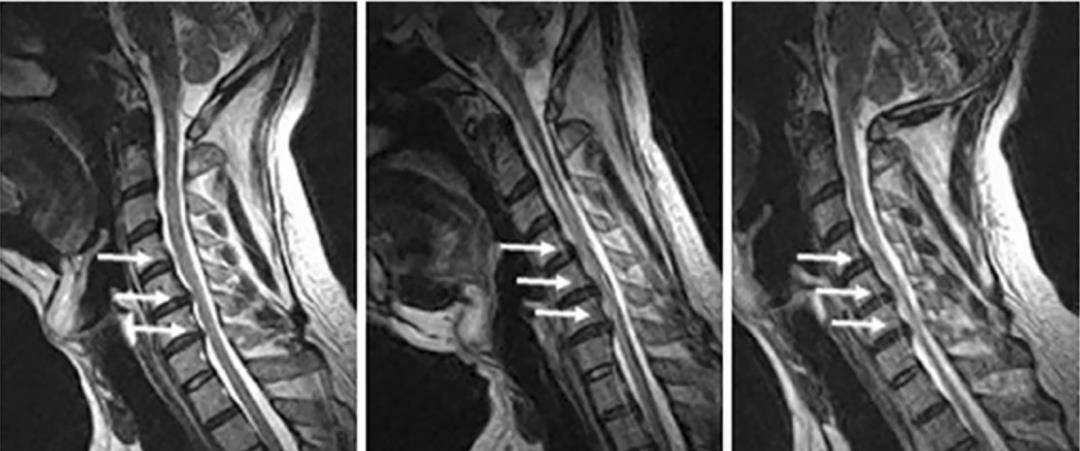 脊髓型颈椎病的诊治，一旦明白定断，建议及时手术治疗