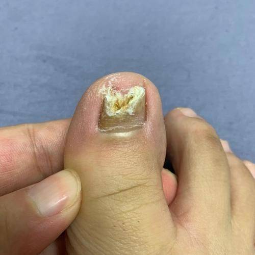 灰指甲的成因：你可能一直都不知道！