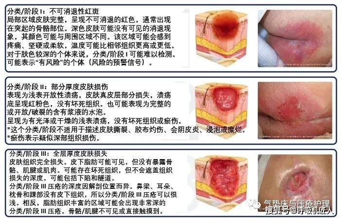 压疮分类指南