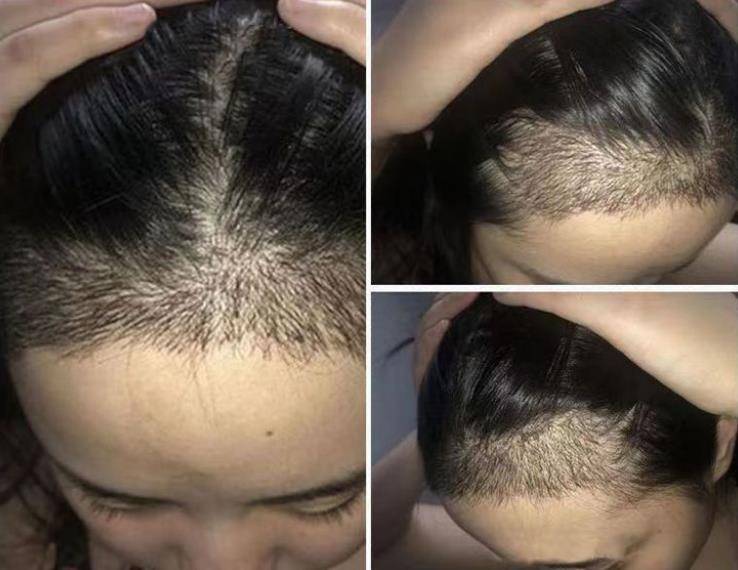 用什么洗发水可以增长头发？脱发有救了