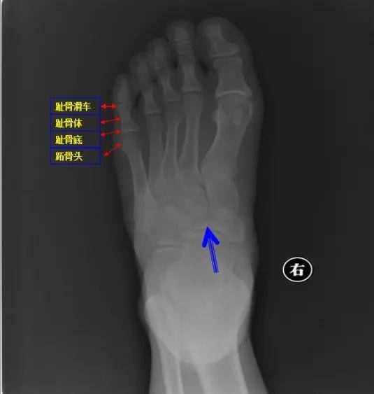 右侧第1趾骨远节趾骨骨折右图:第1趾远节趾骨基底部细小骨折左图:第1