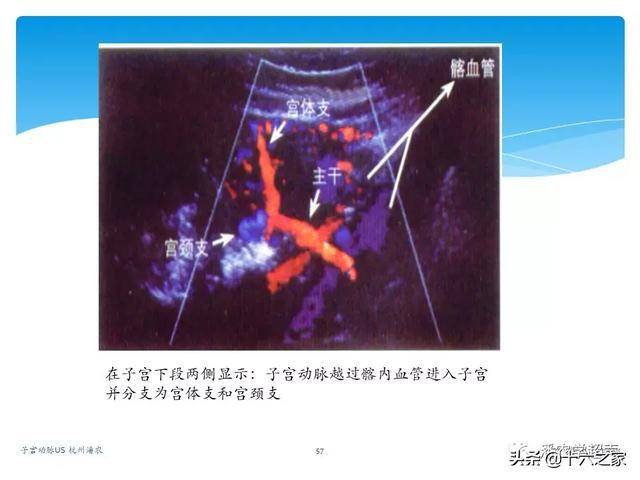 子宫动脉超声检查