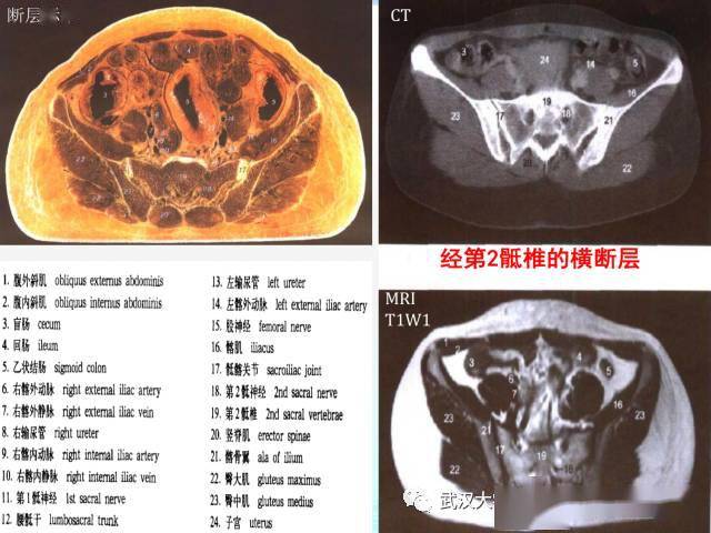 女性盆腔解剖与断层影像