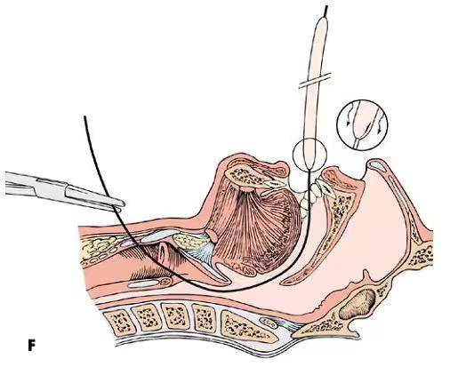 实用技术逆行引导气管插管
