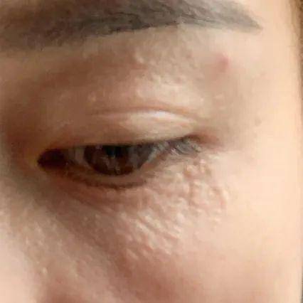 干货分享 | "脂肪粒"抠不出脂肪,闭口和黑头其实是一家人