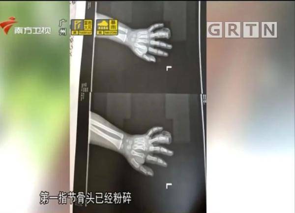 [健身]需截肢！家长用鸡爪测试后发现……，警惕丨4岁男童手指被健身器材夹伤